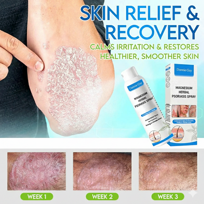 Magnesium Herbal Psoriasis Spray