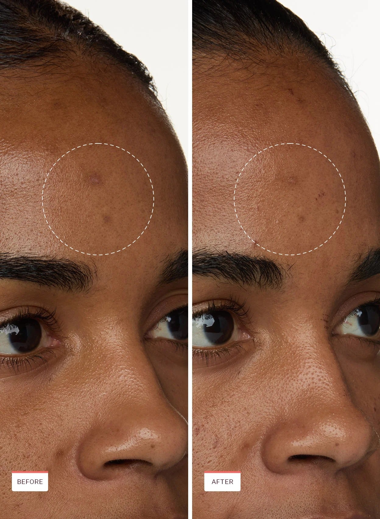 Smoothing Solution Ingrown Hair Treatment - Buy Two Get One Free